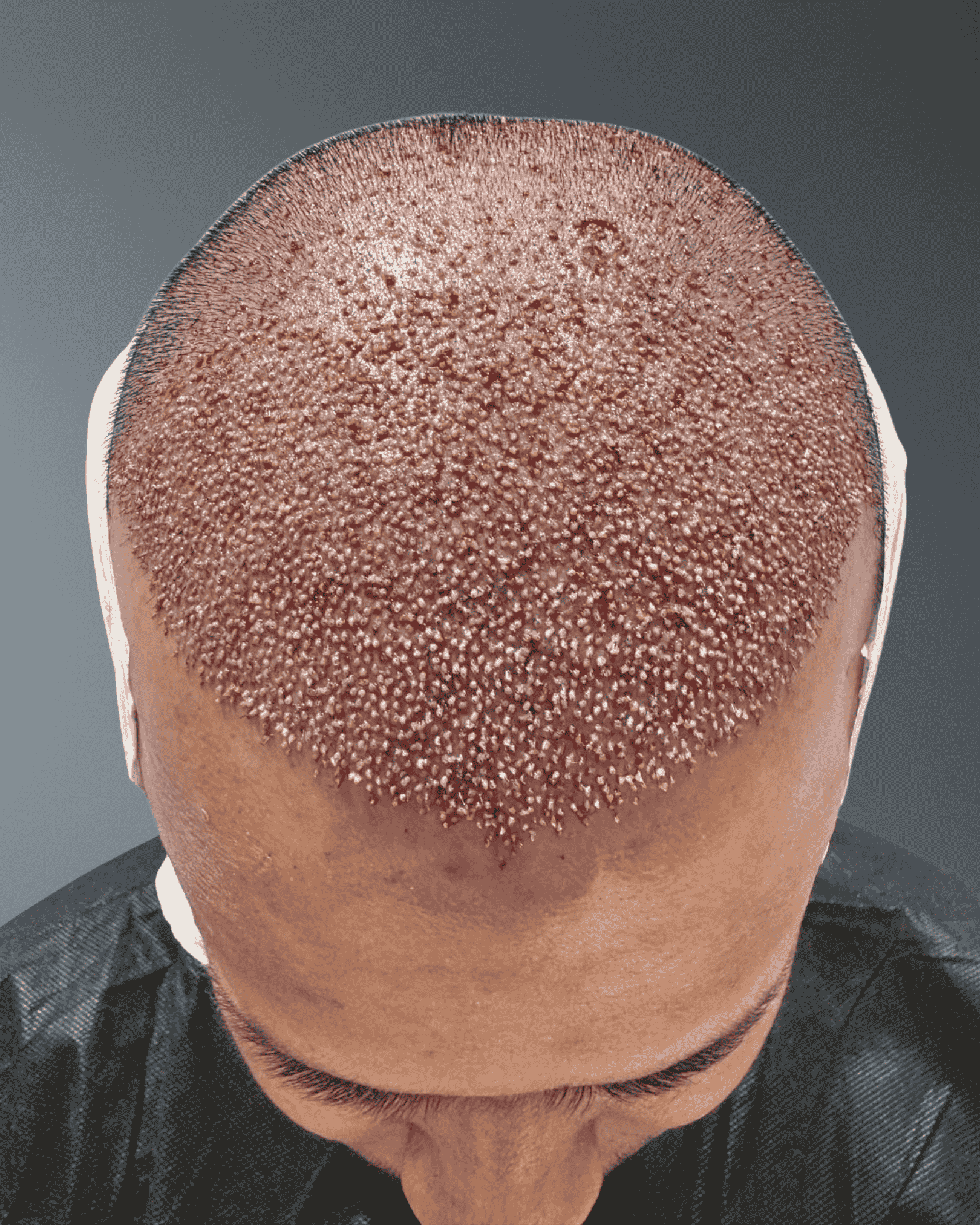 DHI Hair Transplant